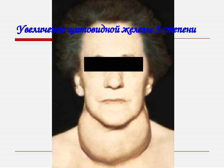 Увеличение щитовидной железы 5 степени 