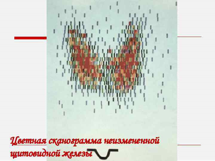 Цветная сканограмма неизмененной щитовидной железы 