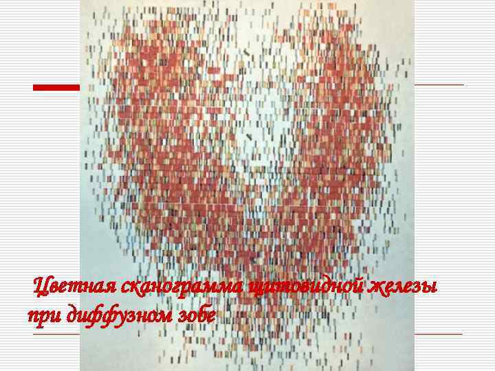 Цветная сканограмма щитовидной железы при диффузном зобе 