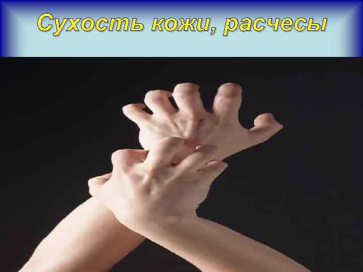 Сухость кожи, расчесы 