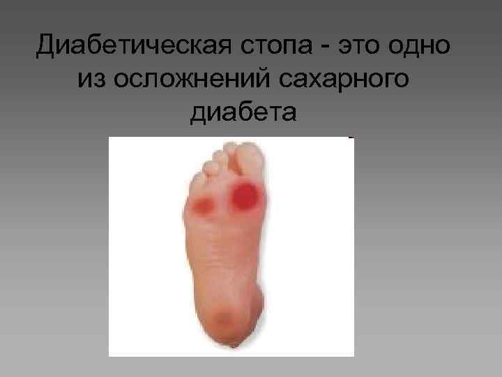 Диабетическая стопа - это одно из осложнений сахарного диабета 
