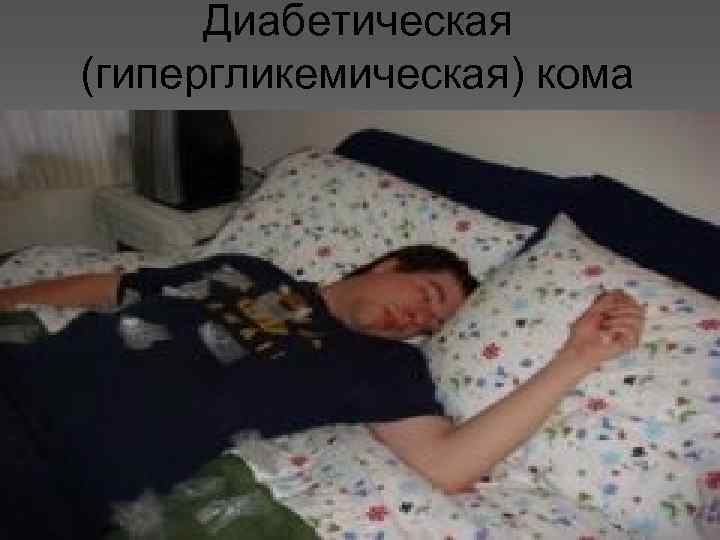 Диабетическая (гипергликемическая) кома 