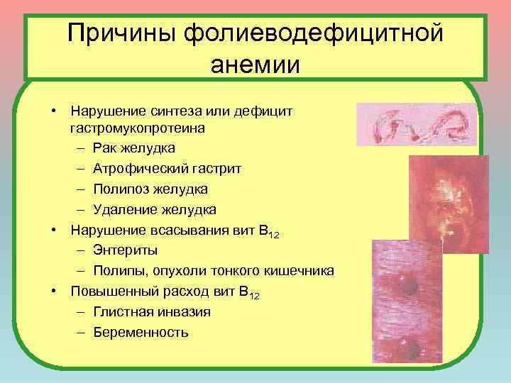 Причины фолиеводефицитной анемии • Нарушение синтеза или дефицит гастромукопротеина – Рак желудка – Атрофический