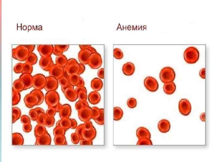 Сп при анемия железодефицитная анемия