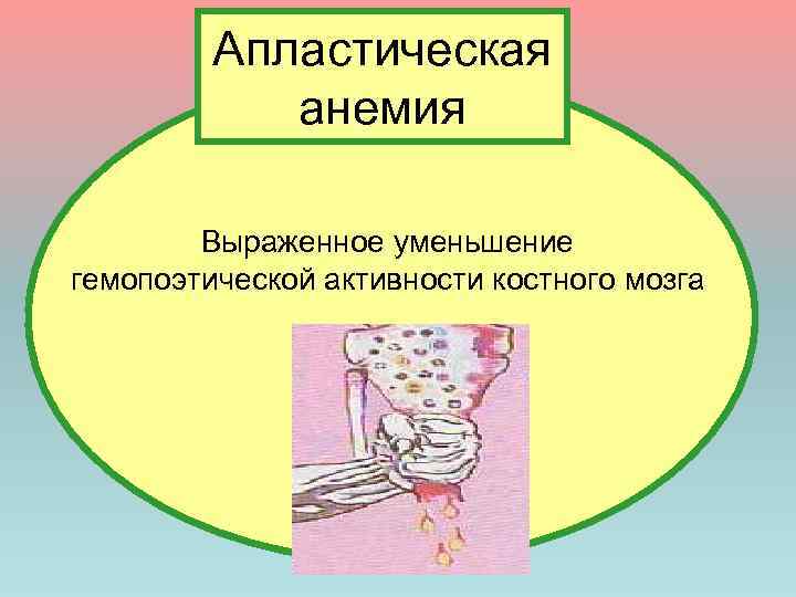 Апластическая анемия Выраженное уменьшение гемопоэтической активности костного мозга 