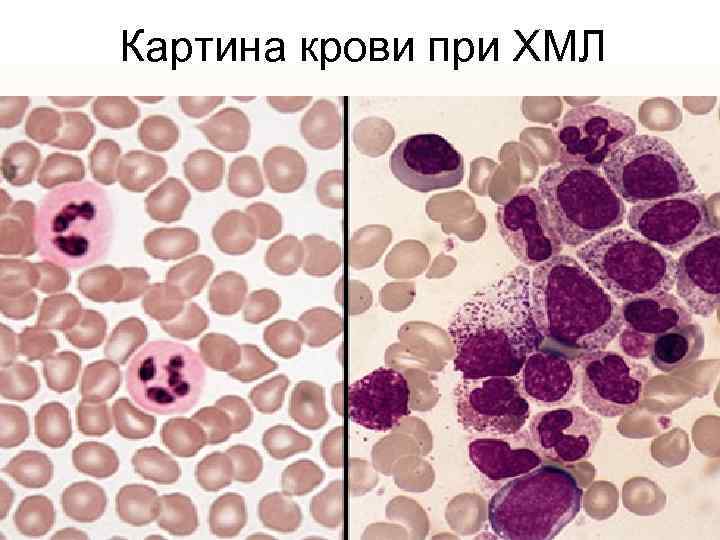 Картина крови при ХМЛ 