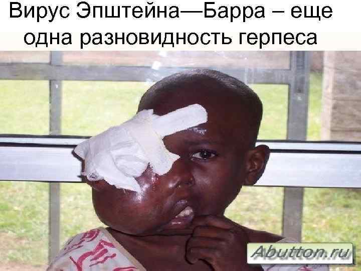 Вирус Эпштейна—Барра – еще одна разновидность герпеса 