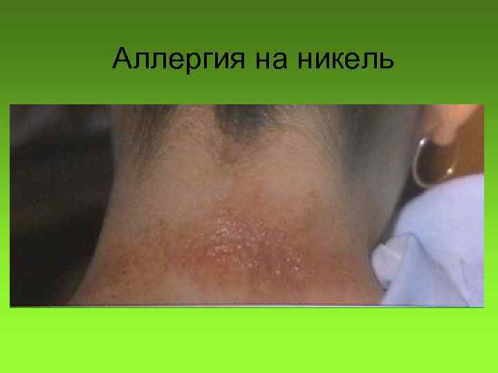 Аллергия на никель 