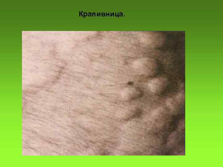 Крапивница. 