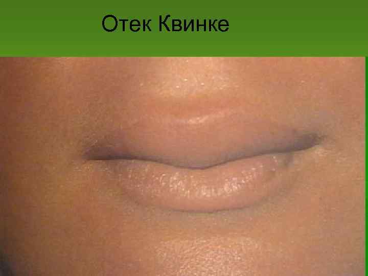 Отек Квинке 