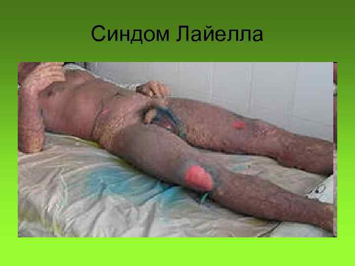 Синдом Лайелла 