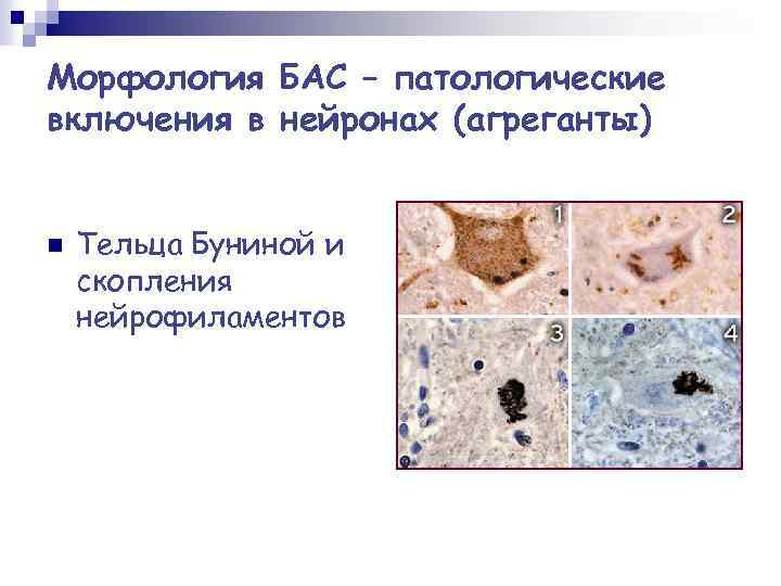Морфология БАС – патологические включения в нейронах (агреганты) n Тельца Буниной и скопления нейрофиламентов