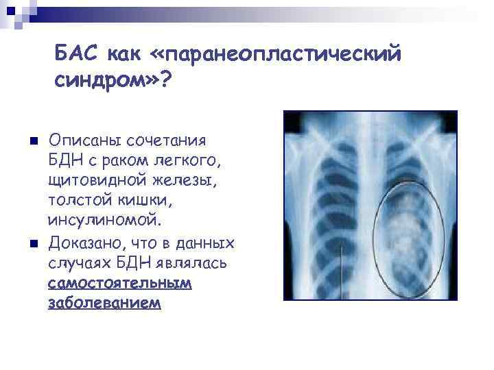 БАС как «паранеопластический синдром» ? n n Описаны сочетания БДН с раком легкого, щитовидной