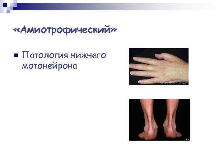  «Амиотрофический» n Патология нижнего мотонейрона 