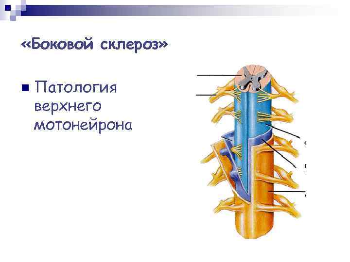  «Боковой склероз» n Патология верхнего мотонейрона 
