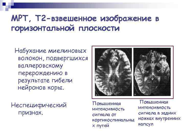 МРТ, Т 2 -взвешенное изображение в горизонтальной плоскости Набухание миелиновых волокон, подвергшихся валлеровскому перерождению