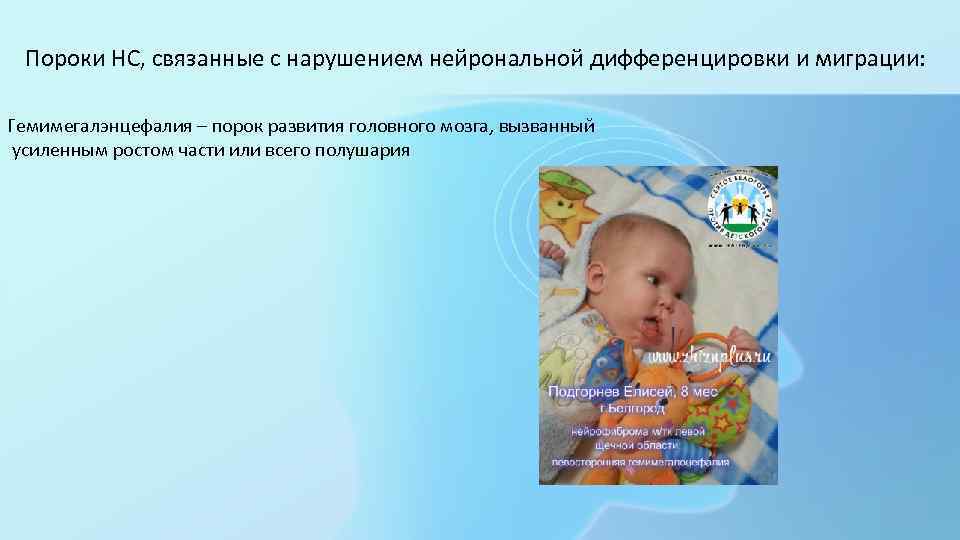 Пороки НС, связанные с нарушением нейрональной дифференцировки и миграции: Гемимегалэнцефалия – порок развития головного