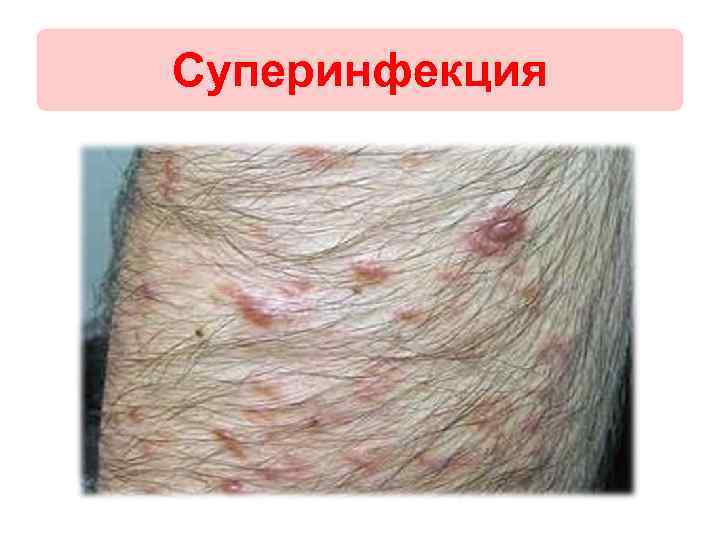 Суперинфекция 