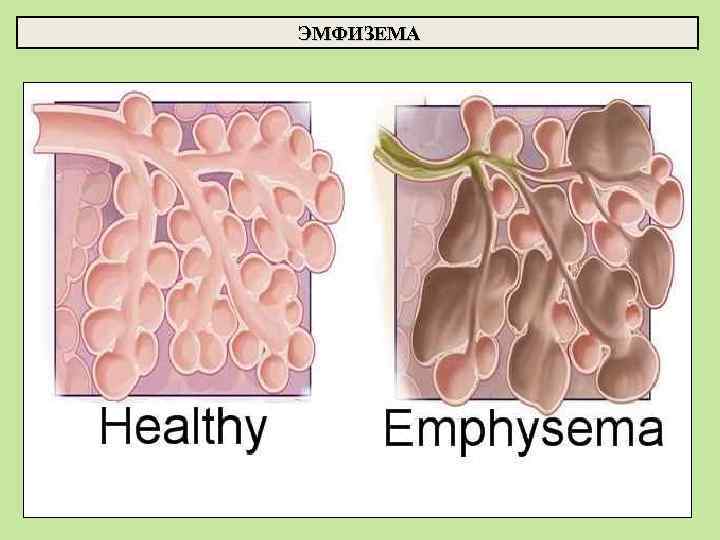 ЭМФИЗЕМА 