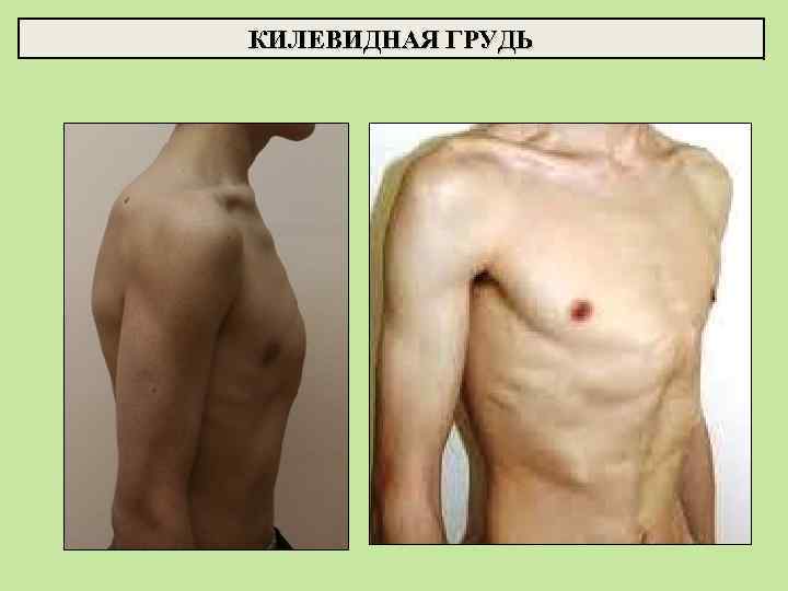 КИЛЕВИДНАЯ ГРУДЬ 