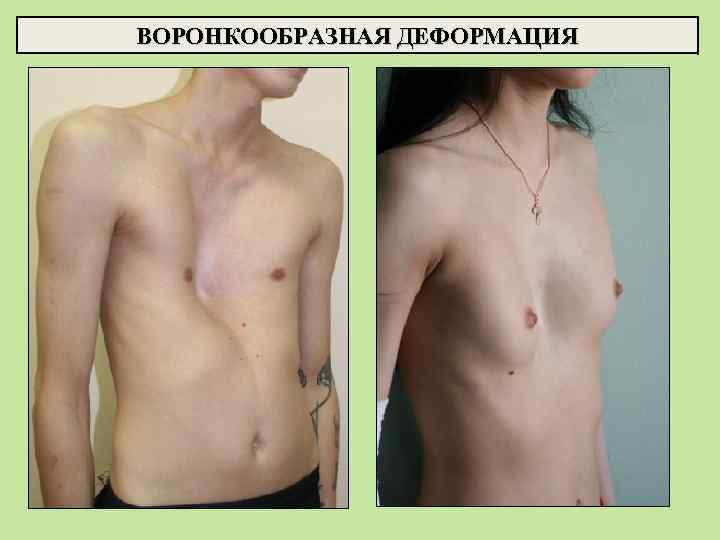 ВОРОНКООБРАЗНАЯ ДЕФОРМАЦИЯ 