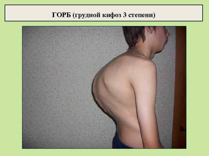 ГОРБ (грудной кифоз 3 степени) 