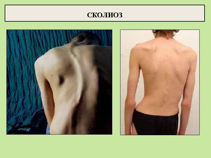 СКОЛИОЗ 
