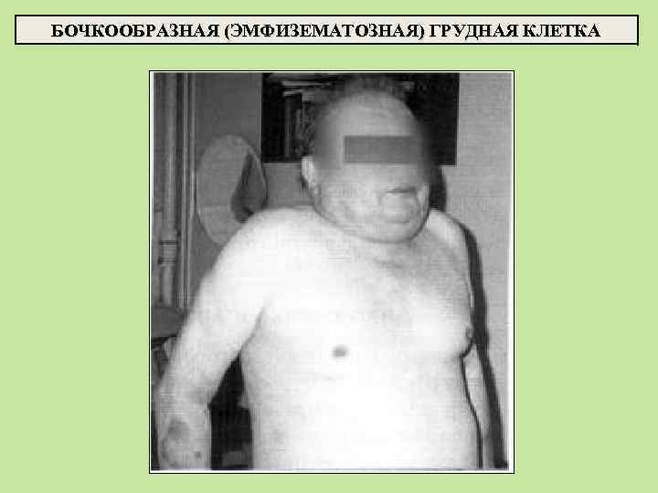 БОЧКООБРАЗНАЯ (ЭМФИЗЕМАТОЗНАЯ) ГРУДНАЯ КЛЕТКА 