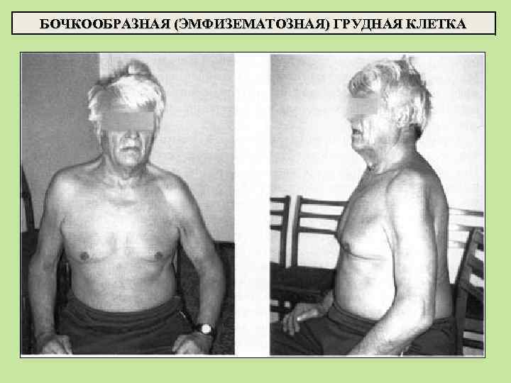 БОЧКООБРАЗНАЯ (ЭМФИЗЕМАТОЗНАЯ) ГРУДНАЯ КЛЕТКА 