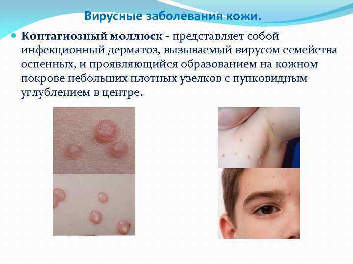 Вирусные заболевания кожи. Контагиозный моллюск - представляет собой инфекционный дерматоз, вызываемый вирусом семейства оспенных,