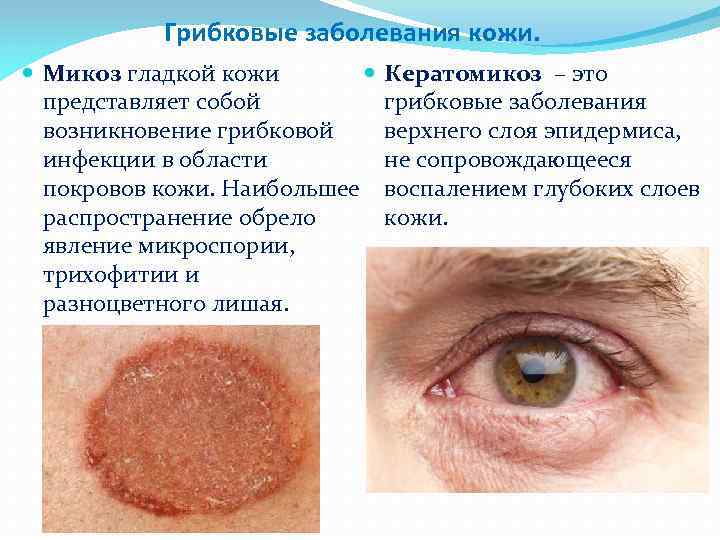 Грибковые заболевания кожи. Микоз гладкой кожи представляет собой возникновение грибковой инфекции в области покровов