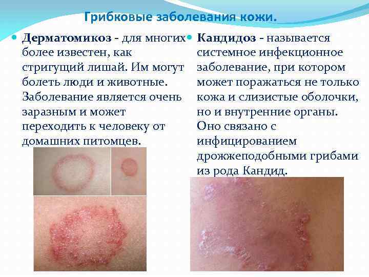 Грибковые заболевания кожи. Дерматомикоз - для многих более известен, как стригущий лишай. Им могут