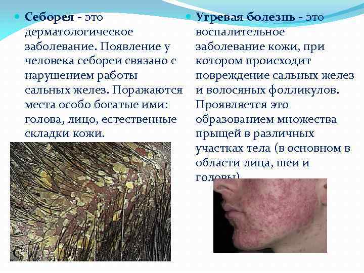  Себорея - это дерматологическое заболевание. Появление у человека себореи связано с нарушением работы