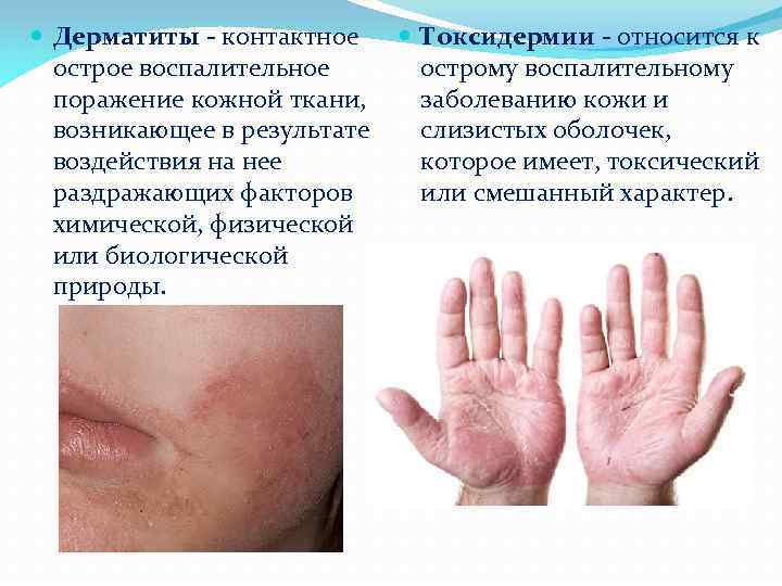  Дерматиты - контактное Токсидермии - относится к острому воспалительному острое воспалительное заболеванию кожи