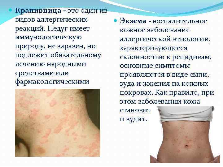 Крапивница - это один из видов аллергических Экзема - воспалительное реакций. Недуг имеет