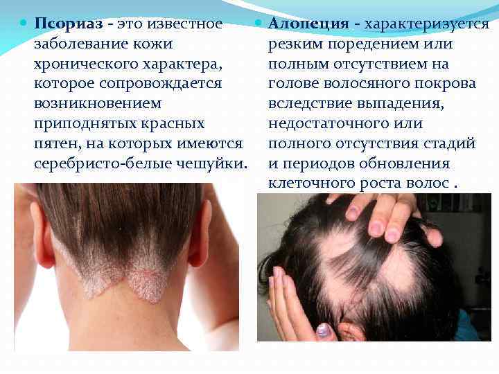  Алопеция - характеризуется Псориаз - это известное резким поредением или заболевание кожи полным