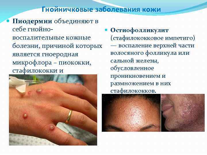 Гнойничковые заболевания кожи Пиодермии объединяют в себе гнойно воспалительные кожные болезни, причиной которых является