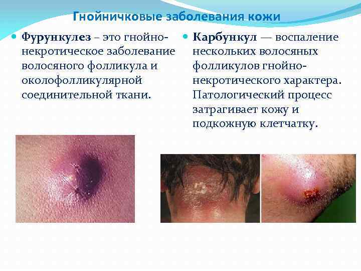 Гнойничковые заболевания кожи Фурункулез – это гнойно- некротическое заболевание волосяного фолликула и околофолликулярной соединительной
