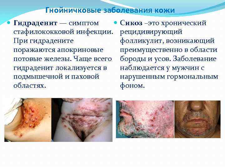 Гнойничковые заболевания кожи Гидраденит — симптом стафилококковой инфекции. При гидрадените поражаются апокриновые потовые железы.