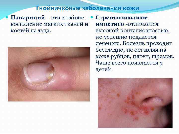 Гнойничковые заболевания кожи Панариций – это гнойное Стрептококковое воспаление мягких тканей и импетиго -отличается
