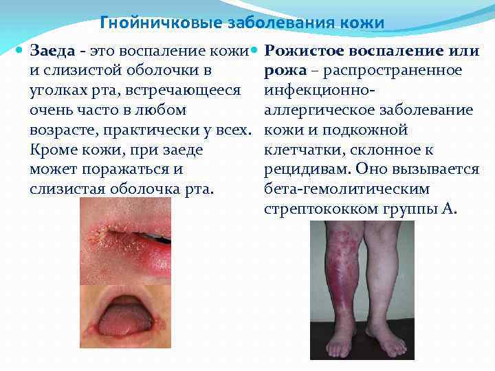 Гнойничковые заболевания кожи Заеда - это воспаление кожи и слизистой оболочки в уголках рта,