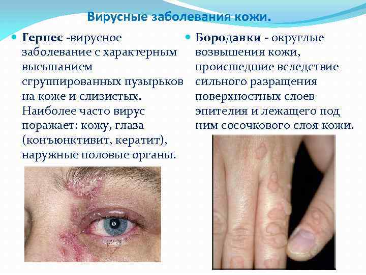 Вирусные заболевания кожи. Герпес -вирусное заболевание с характерным высыпанием сгруппированных пузырьков на коже и