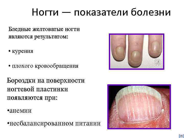 Ногти — показатели болезни Бледные желтоватые ногти являются результатом: • курения • плохого кровообращения