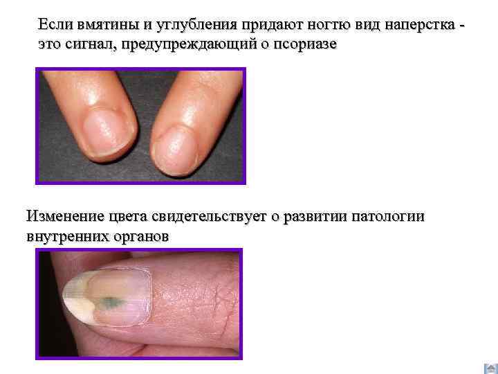 Если вмятины и углубления придают ногтю вид наперстка это сигнал, предупреждающий о псориазе Изменение