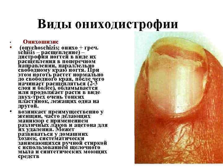 Виды ониходистрофии • Онихошизис • (onychoschizis; онихо + греч. schisis – расщепление) – дистрофия