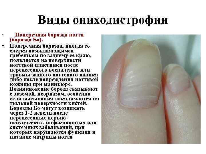 Виды ониходистрофии • Поперечная борозда ногтя (борозда Бо). • Поперечная борозда, иногда со слегка