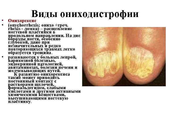 Виды ониходистрофии Онихорексис • • (onychorrhexis; онихо +греч. rhexis - ломка) – расщепление ногтевой