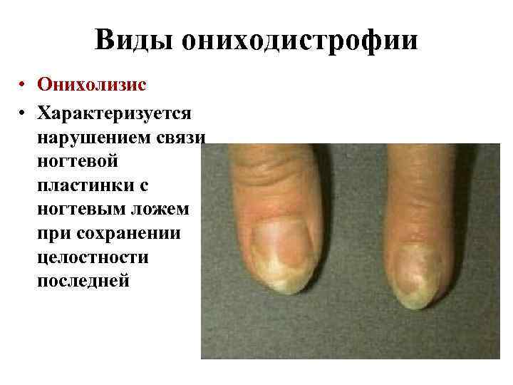 Виды ониходистрофии • Онихолизис • Характеризуется нарушением связи ногтевой пластинки с ногтевым ложем при