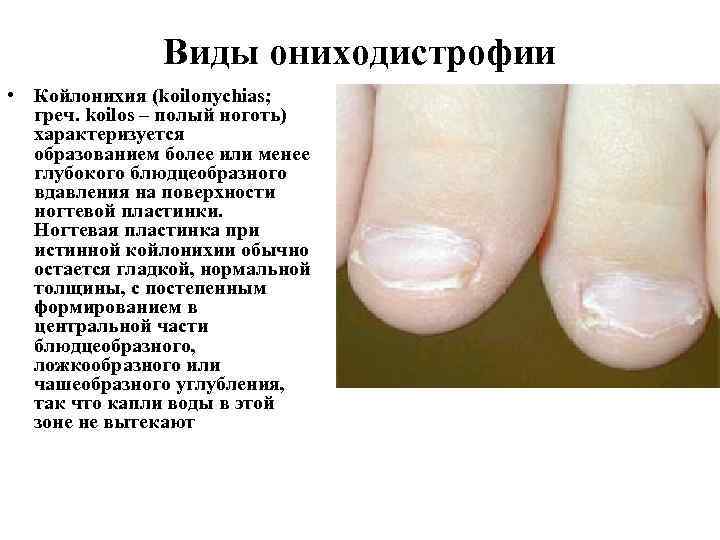 Виды ониходистрофии • Койлонихия (koilonychias; греч. koilos – полый ноготь) характеризуется образованием более или