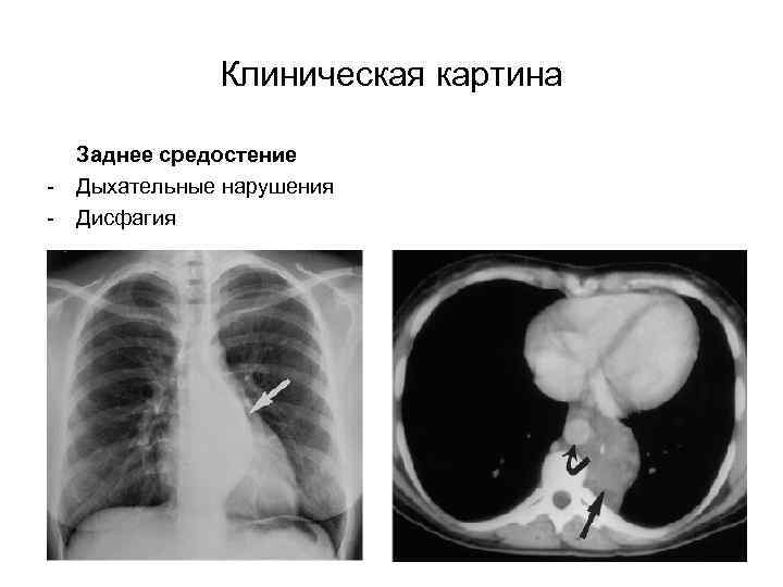 Клиническая картина - Заднее средостение Дыхательные нарушения Дисфагия 